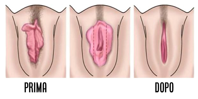 labioplastica